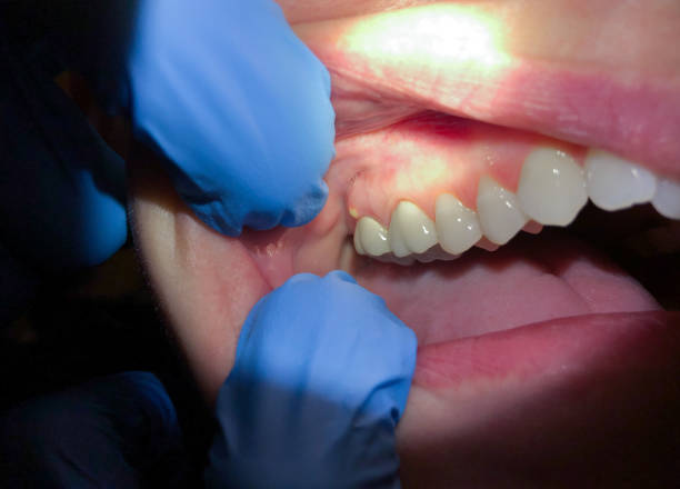 Best Emergency Wisdom Tooth Extraction in La Marque, TX